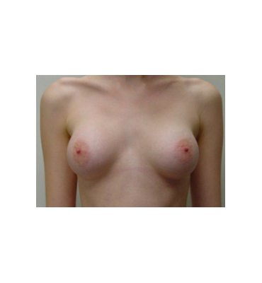 After Breast Augmentation